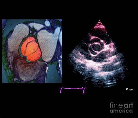 Aortic Valve Congenital Deformity Photograph By Zephyrscience Photo