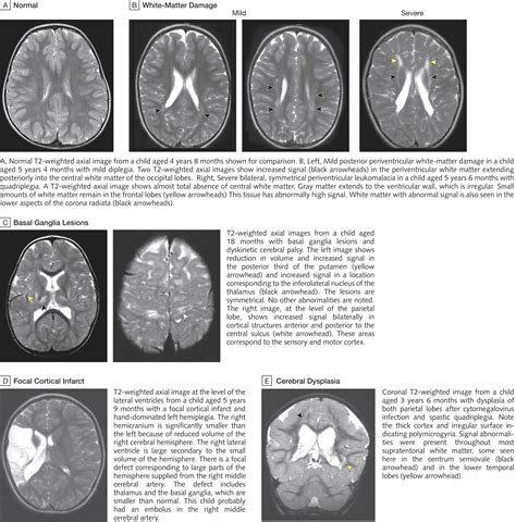 Clinical And Mri Correlates Of Cerebral Palsy Neurology Jama The