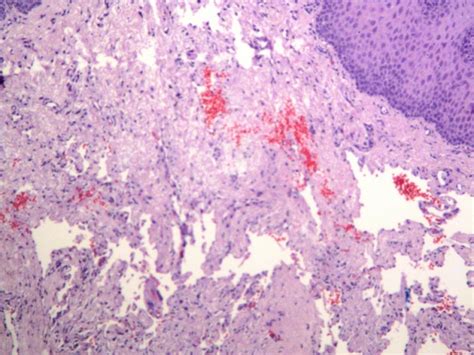 Cavernous Lip Hemangioma Download Scientific Diagram