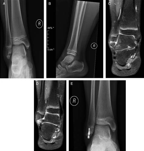 Atypical Chronic Ankle Instability In A Pediatric Population Secondary