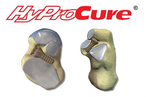 Hyprocure Recognized As The Most Powerful Minimally Invasive Procedure In Foot And Ankle Surgery
