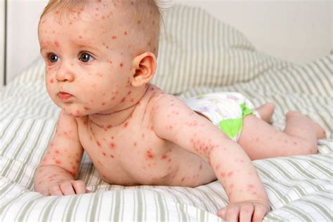 Skin Rashes Kids Causes And Methods Of Treatment Body