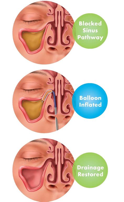 Balloon Sinus Dilation Nasal Balloon St Louis Sinus Center