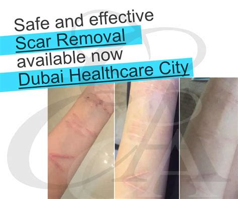 Scar Removal Dubai And The Middle East Exclusive Aesthetic Dubai