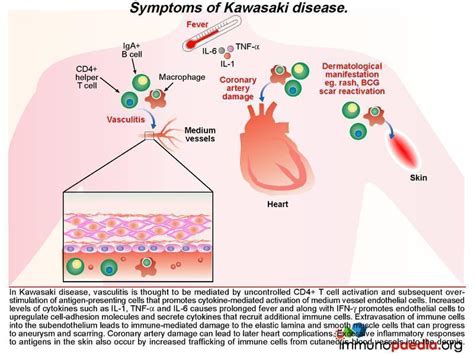 Kawasaki Disease Case Study Immunopaedia