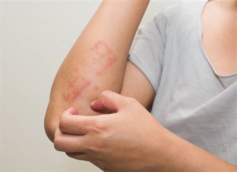 Dermatite atopica cosè e come trattarne i sintomi