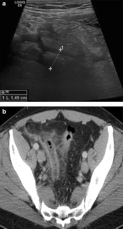 Us And Ct In Acute Appendicitis 45 Year Old Male Patient With Pain In