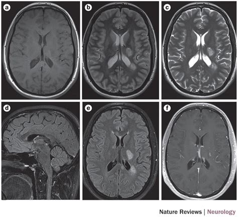 Standardized Brain Mri Protocol To Evaluate Patients In Whom Multiple