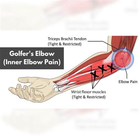 Golfers Elbow Pain Root Cause And Fastest Way To Fix
