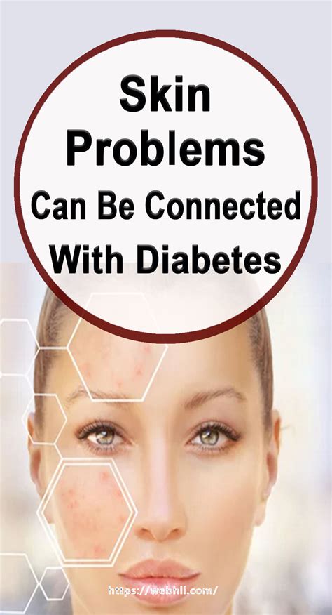 Skin Problems Can Be Connected With Diabetes Healthy Lifestyle