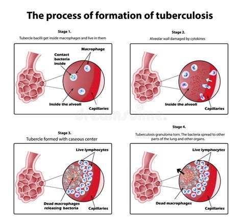 The Process Of Tuberculosis Formation Infographics Vector