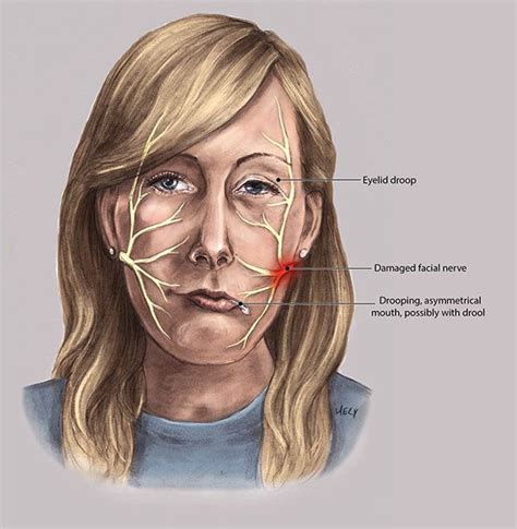 Facial Nerve And Bells Palsy On Behance Facial Nerve Bells Palsy Nerve