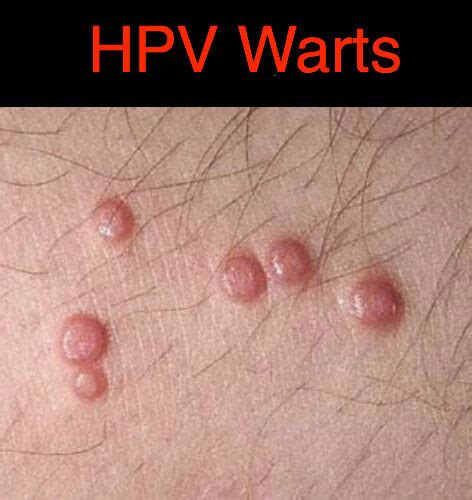 Hpv Genital Warts Ointment Oz Ml With Green Tea Extract Ebay