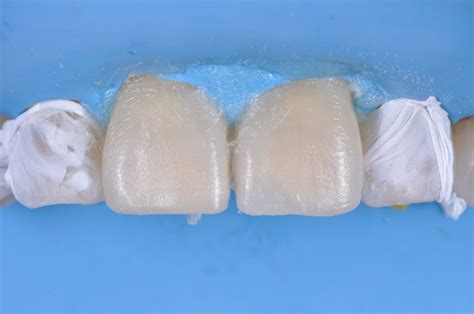 Fast Single Shade Anterior Restorations With Flowable Composite The