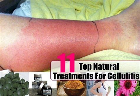 Treatments For Cellulitis Cellulitis Treatment Natural Cures