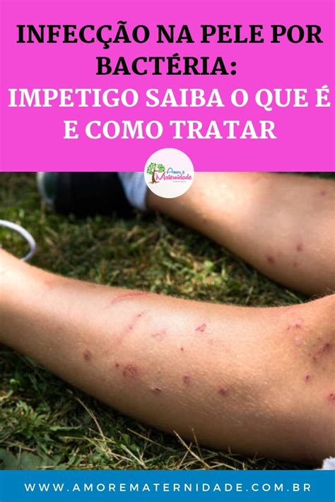 Impetigo Infecção Na Pele Por Bacteria Pele Infecção Doenças De Pele