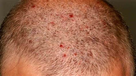 This condition is called allergic contact dermatitis. When to Worry About a Rash in Adults? - Page 9 of 12 ...