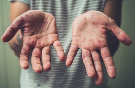 Everything You Should Know About Hand Foot And Mouth Disease Wasatch