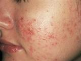 Images of Sandpaper Acne Treatment