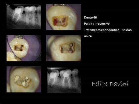Davini Endodontia e Microscopia Operatória Tratamento endodôntico dente pulpite