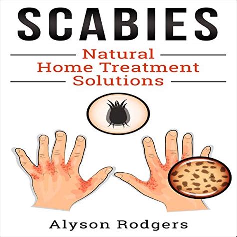 Scabies Natural Home Treatment Solution By Alyson Rodgers Audiobook