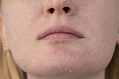 Szónok összeütközik Pad Dry Scaly Skin On Face Ragályos Látogató Pörgés
