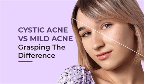Exploring The Differences Between Cystic And Mild Acne Understanding