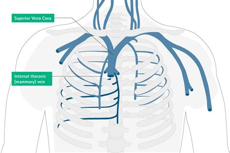 Misplacement And Malposition Of Central Venous Catheters