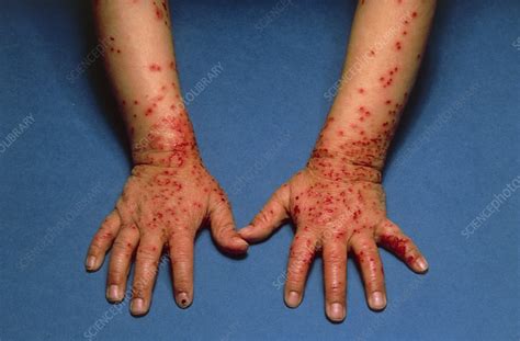 Eczema Herpeticum Of Wrist And Hands Stock Image M1500026