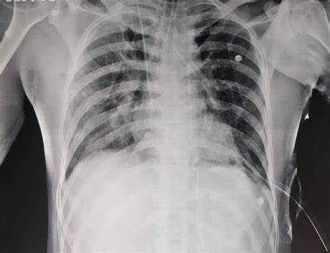 Immediate Post Operative Chest X Ray Showing Complete Expansion Of The