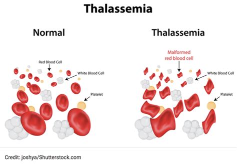 Beta Thalassemia Checkrare