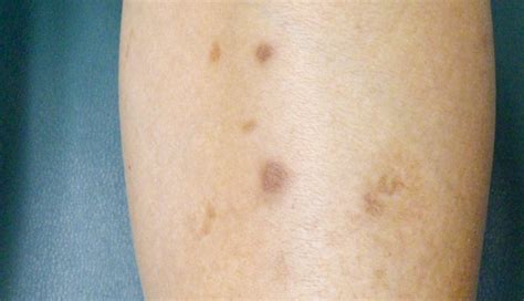 Light Brown Spots On Lower Legs