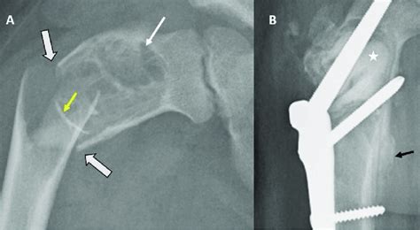 Simple Bone Cyst Frontal Radiograph Of The Right Femur A