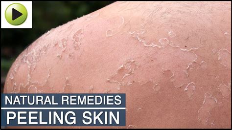 Skin Care Peeling Skin Natural Ayurvedic Home Remedies Youtube