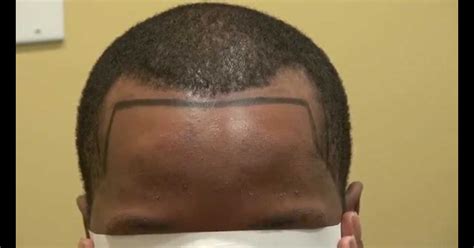 View How To Fix Receding Hairline Black Male