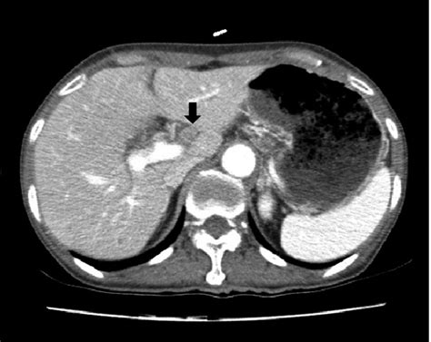 Abdominal Computed Tomography Shows Enlarged Lymph Nodes With Central
