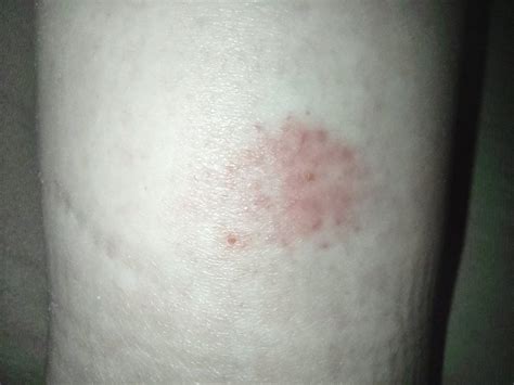 Woke Up With This On My Ankle A Few Days Ago Itches Is It An Insect