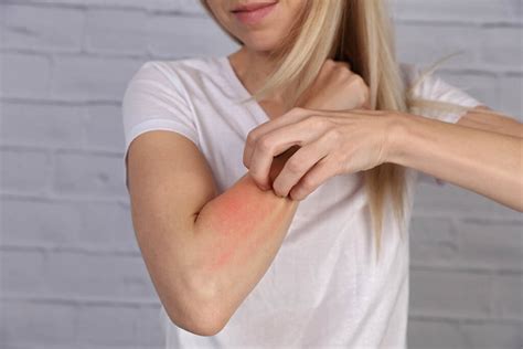 Dermatite Irritativa Cause Sintomi E Rimedi
