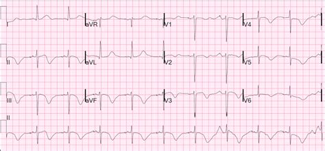 Dr Smith S Ecg Blog Long Qt Syndrome With Continuously Recurrent