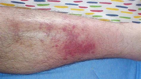 Bacteria from the streptococcus and staphylococcus groups are common on the surface of the skin, where they are not. What can i do for cellulitis in my legs ...