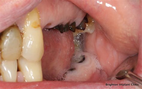 Bad Teeth Decayed Teeth Affected Dental Implants