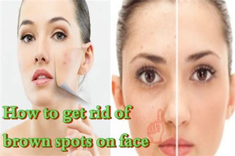 What Are These Brown Spots On Face And How To Treat Them Hergamut