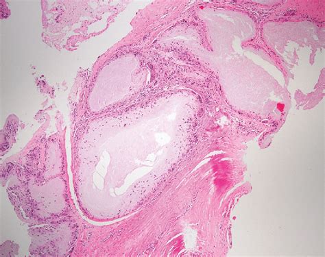 A Microscopic Image Showing A Typical Granuloma Of A Gouty Tophus