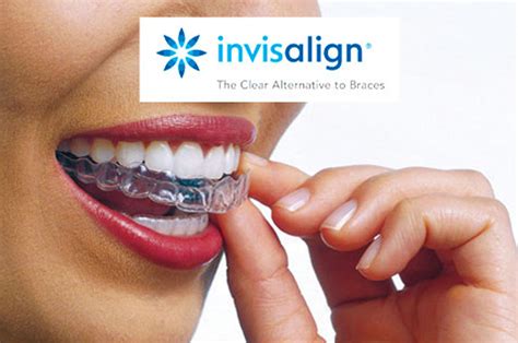 Focus On Invisalign Dentist Leeds Fhdc