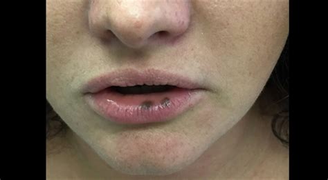 Clinical Challenge Dark Spots On The Lips Mpr