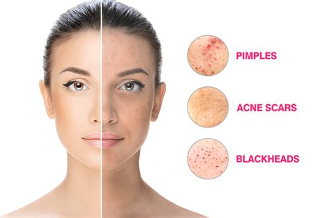 What Are The Main Acne Issues And How To Deal With Them Dr Sushma Raavi