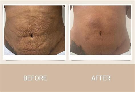 Bandv After Lipo Care Lymphatic And Fibrosis Post Surgery Care