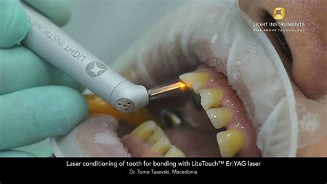 Laser Conditioning Of Tooth For Bonding With Litetouch™ Eryag Laser