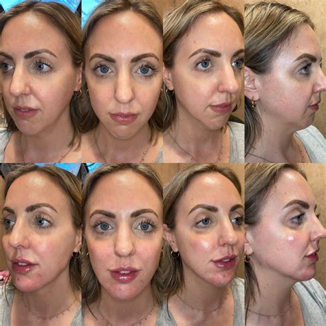 My Experience With Jawline Cheek And Lip Filler Radiesse And Restylane