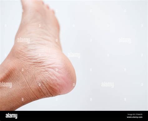 Dry And Cracked Soles Of Feet On A White Background Cracked Skins